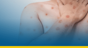 Casos de mpox dobram em poucas semanas e acendem alerta no Brasil