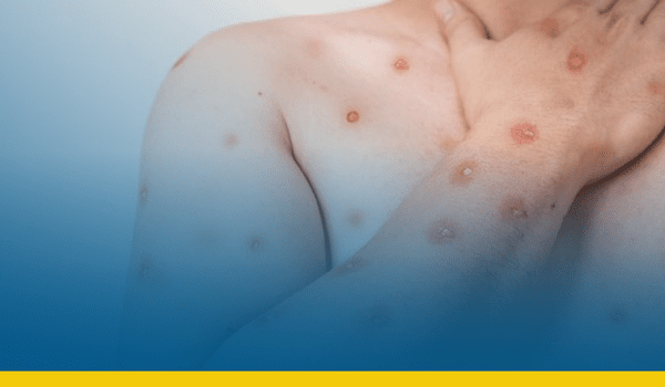 Casos de mpox dobram em poucas semanas e acendem alerta no Brasil