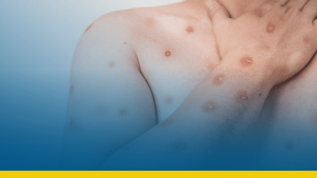 Casos de mpox dobram em poucas semanas e acendem alerta no Brasil