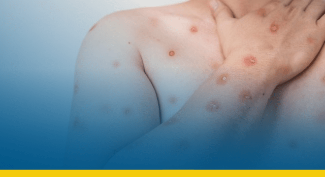 Casos de mpox dobram em poucas semanas e acendem alerta no Brasil